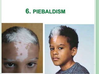 6. PIEBALDISM
 