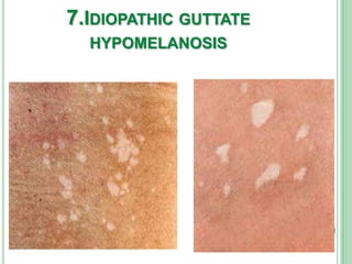 7.IDIOPATHIC GUTTATE
HYPOMELANOSIS
 