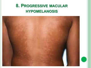 8. PROGRESSIVE MACULAR
HYPOMELANOSIS
 