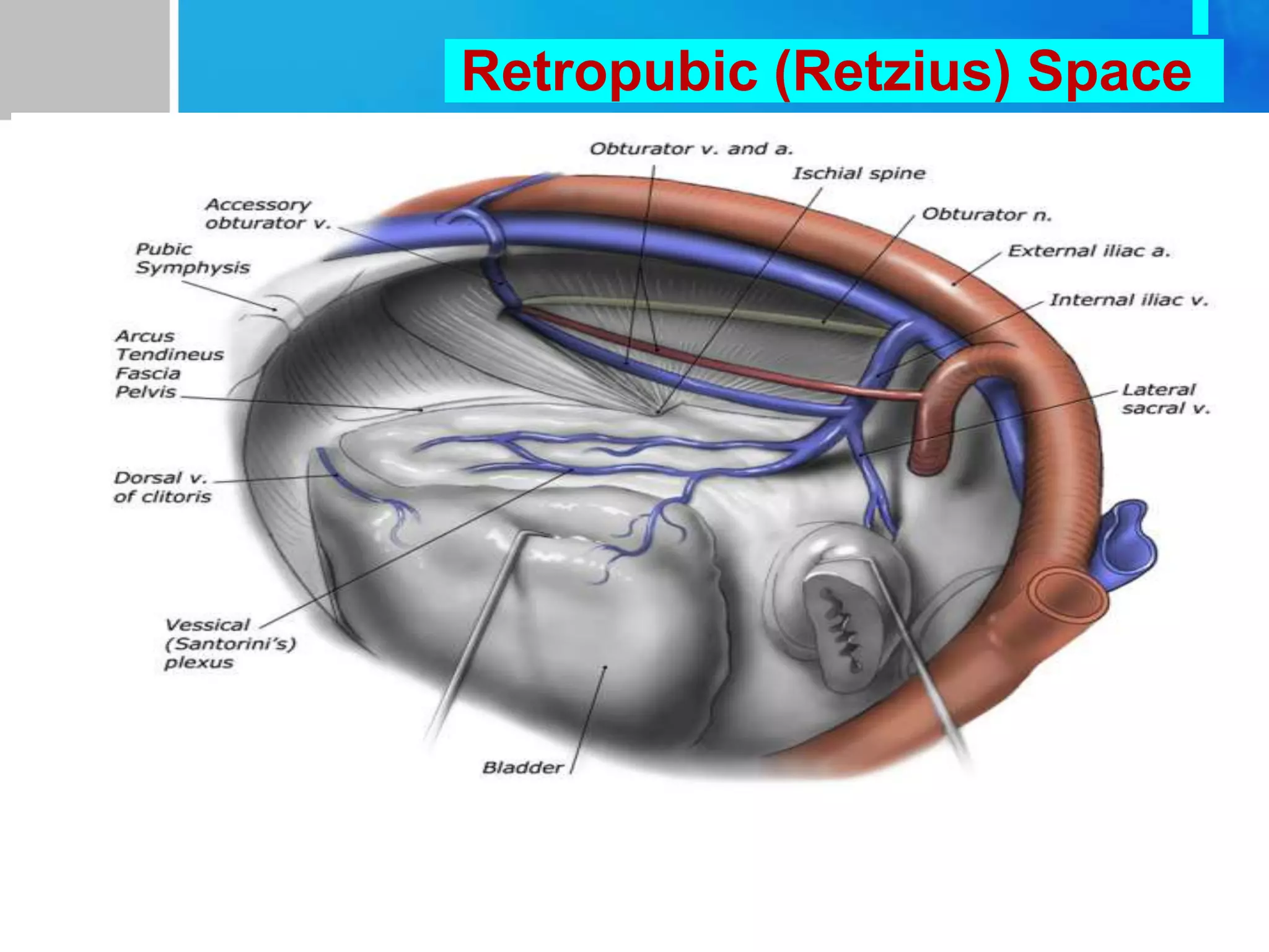 Tooth Retzius Seminar on Management of pelvic hemorrhage.pptx