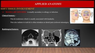 APPLIED ANATOMY
 MAXILLARY SINUSITIS : is usually secondary to allergy or infection.
Clinical features –
Pain & tenderness which is usually associated with headache.
Pain also radiates to teeth & is often mistaken as dental pain (referred odontalgia).
Radiological features-
SOFT TISSUE INVOLVEMENT :
 