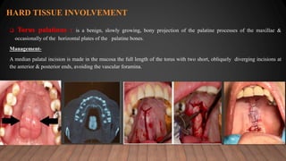  Torus palatinus : is a benign, slowly growing, bony projection of the palatine processes of the maxillae &
occasionally of the horizontal plates of the palatine bones.
Management-
A median palatal incision is made in the mucosa the full length of the torus with two short, obliquely diverging incisions at
the anterior & posterior ends, avoiding the vascular foramina.
HARD TISSUE INVOLVEMENT
 