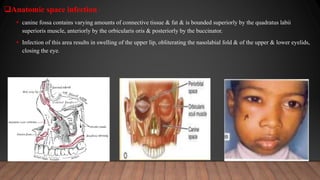 Anatomic space infection :
 canine fossa contains varying amounts of connective tissue & fat & is bounded superiorly by the quadratus labii
superioris muscle, anteriorly by the orbicularis oris & posteriorly by the buccinator.
 Infection of this area results in swelling of the upper lip, obliterating the nasolabial fold & of the upper & lower eyelids,
closing the eye.
 