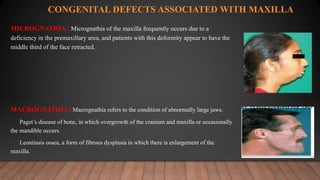 CONGENITAL DEFECTS ASSOCIATED WITH MAXILLA
MICROGNATHIA : Micrognathia of the maxilla frequently occurs due to a
deficiency in the premaxillary area, and patients with this deformity appear to have the
middle third of the face retracted.
MACROGNATHIA : Macrognathia refers to the condition of abnormally large jaws.
Paget’s disease of bone, in which overgrowth of the cranium and maxilla or occasionally
the mandible occurs.
Leontiasis ossea, a form of fibrous dysplasia in which there is enlargement of the
maxilla.
 