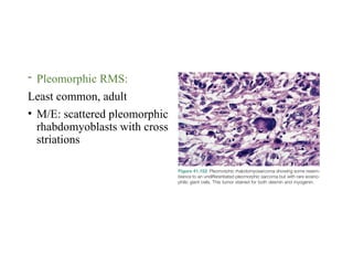 Pleomorphic Rms seminar on mesenchyml tumors- Rovino.pptx