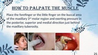 MUSCLES OF MASTICATION INVOLVING ANATOMY , ORIGIN AND INSERTION AND ...