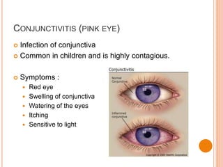 CONJUNCTIVITIS (PINK EYE)
 Infection of conjunctiva
 Common in children and is highly contagious.
 Symptoms :
 Red eye
 Swelling of conjunctiva
 Watering of the eyes
 Itching
 Sensitive to light
 