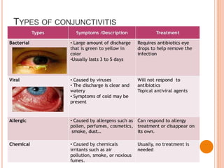 TYPES OF CONJUNCTIVITIS
 