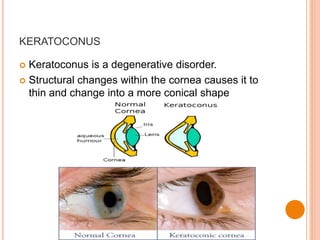 KERATOCONUS
 Keratoconus is a degenerative disorder.
 Structural changes within the cornea causes it to
thin and change into a more conical shape
 