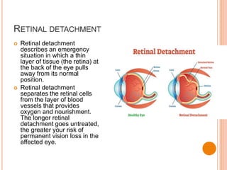 RETINAL DETACHMENT
 Retinal detachment
describes an emergency
situation in which a thin
layer of tissue (the retina) at
the back of the eye pulls
away from its normal
position.
 Retinal detachment
separates the retinal cells
from the layer of blood
vessels that provides
oxygen and nourishment.
The longer retinal
detachment goes untreated,
the greater your risk of
permanent vision loss in the
affected eye.
 