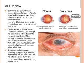 GLAUCOMA
 Glaucoma is a condition that
causes damage to your eye's optic
nerve and gets worse over time.
It's often linked to a buildup of
pressure inside
your eye. Glaucoma tends to be
inherited and may not show up until
later in life.
 The increased pressure, called
intraocular pressure, can damage
the optic nerve, which transmits
images to your brain. If the
damage continues, glaucoma can
lead to permanent vision loss.
Without treatment, glaucoma can
cause total permanent blindness
within a few years.
 Symptoms include severe
throbbing eye pain, Eye redness,
Headaches (on the same side as
the affected eye), Blurry or
foggy vision, Halos around lights,
Dilated pupil
 