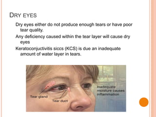 DRY EYES
Dry eyes either do not produce enough tears or have poor
tear quality.
Any deficiency caused within the tear layer will cause dry
eyes
Keratoconjuctivitis siccs (KCS) is due an inadequate
amount of water layer in tears.
 