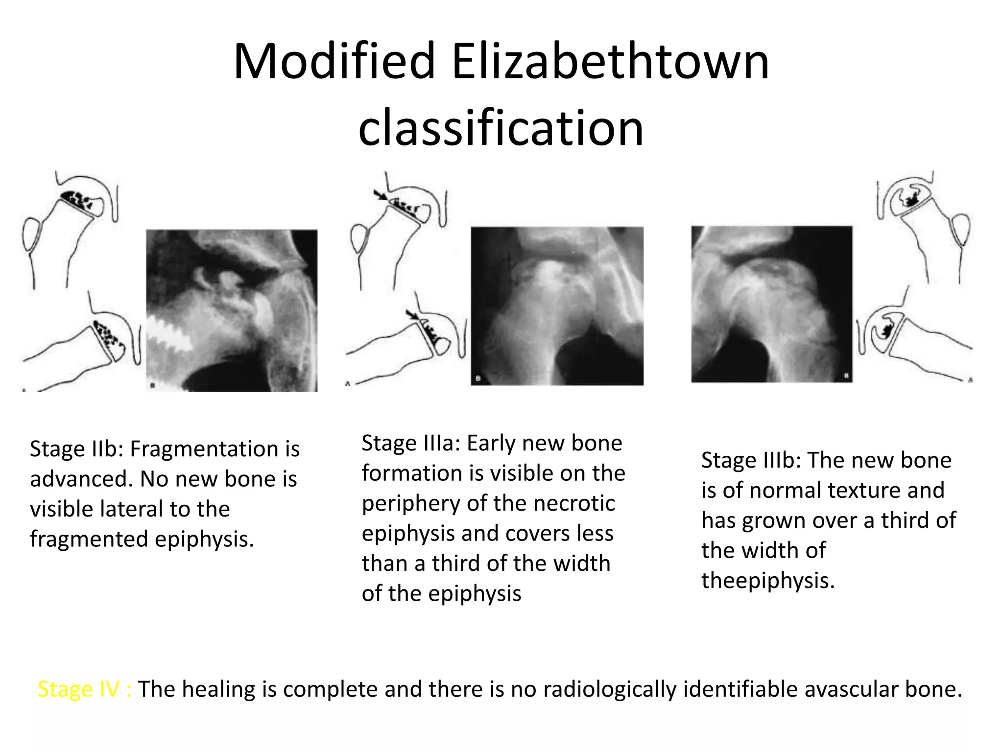 Modified Elizabethtown
classification
Stage IIIa: Early new bone
formation is visible on the
periphery of the necrotic
epiphysis and covers less
than a third of the width
of the epiphysis
Stage IIb: Fragmentation is
advanced. No new bone is
visible lateral to the
fragmented epiphysis.
Stage IIIb: The new bone
is of normal texture and
has grown over a third of
the width of
theepiphysis.
Stage IV : The healing is complete and there is no radiologically identifiable avascular bone.
 