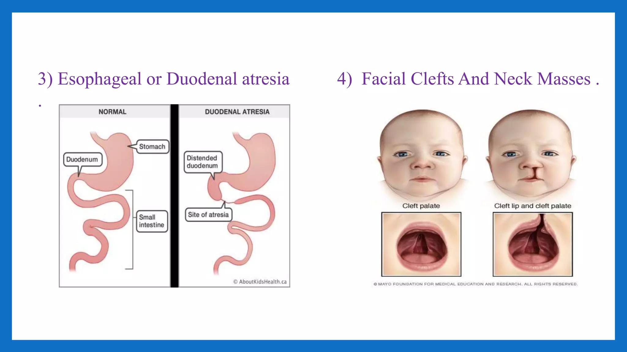 3) Esophageal or Duodenal atresia
.
4) Facial Clefts And Neck Masses .
 