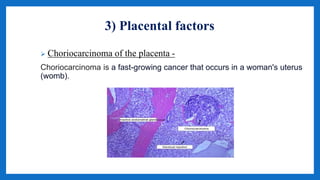 3) Placental factors
 Choriocarcinoma of the placenta -
Choriocarcinoma is a fast-growing cancer that occurs in a woman's uterus
(womb).
 