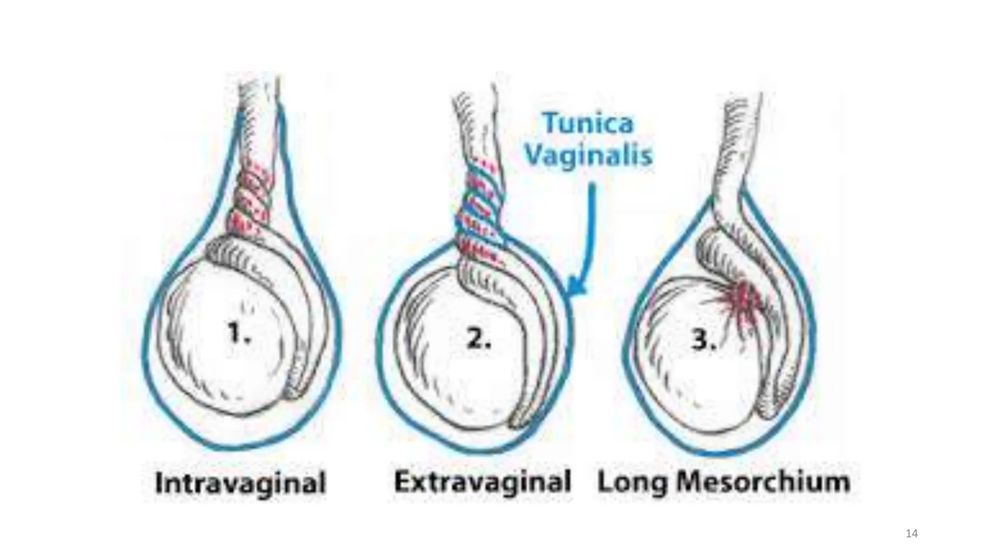 Scrotal and Testicular Swelling.pptx