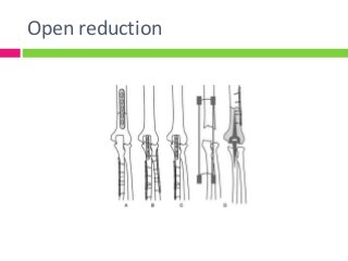 Open reduction
 