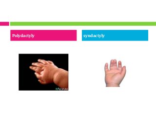 Polydactyly syndactyly
 