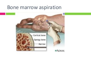 Bone marrow aspiration
 