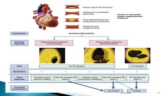 Stemi Events Seminar on STEMI.pptx
