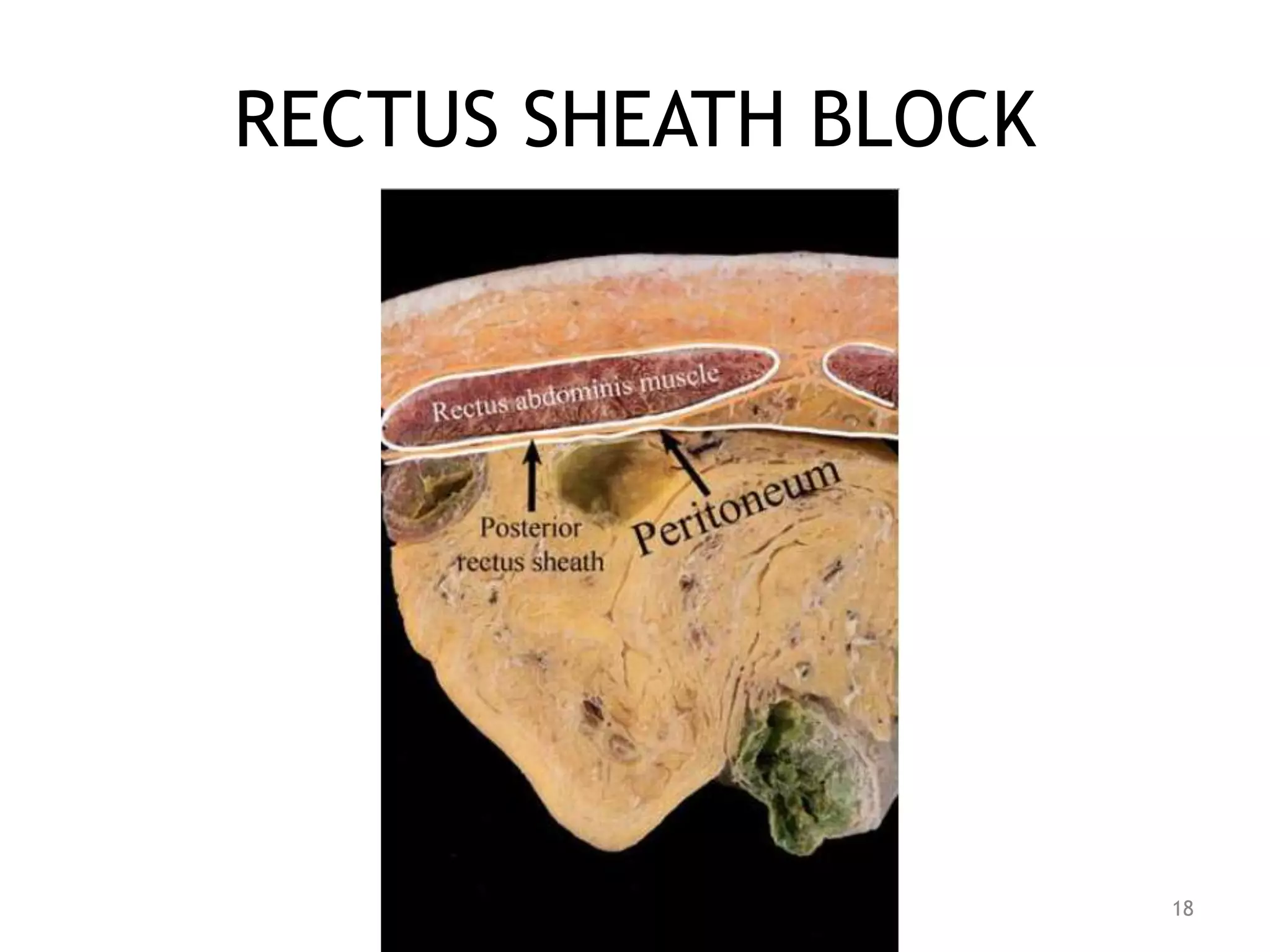RECTUS SHEATH BLOCK
18
 