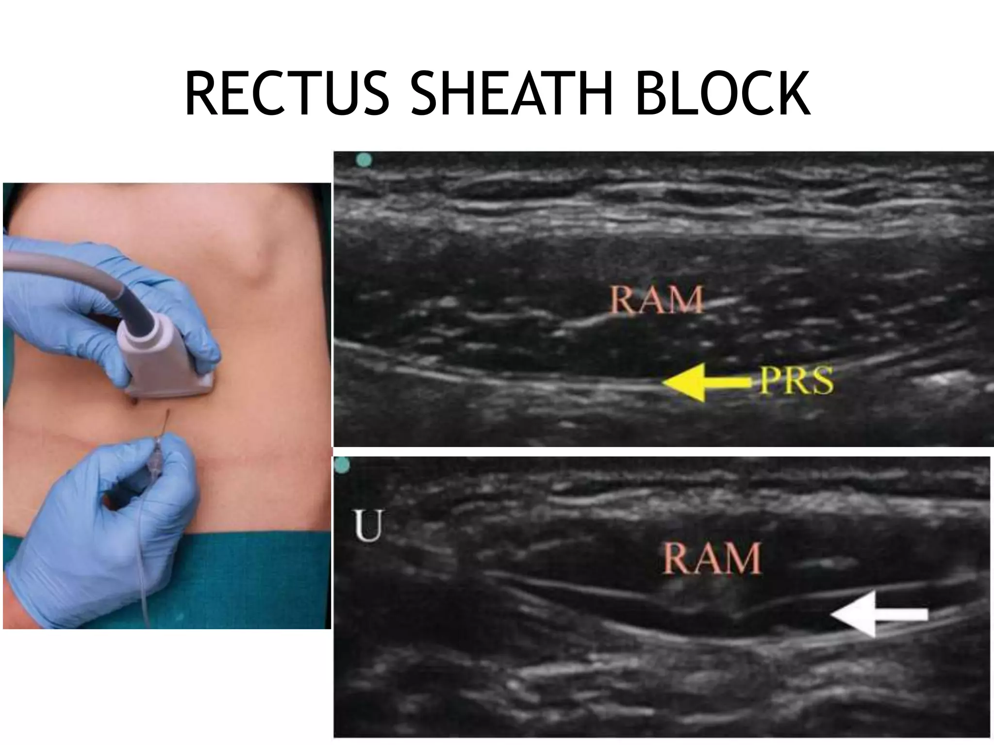 RECTUS SHEATH BLOCK
19
 