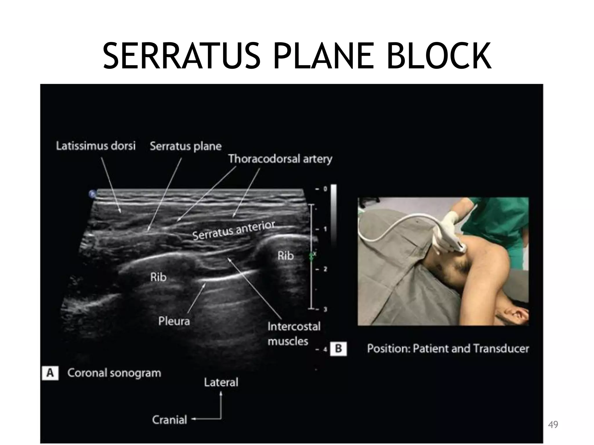 SERRATUS PLANE BLOCK
49
 