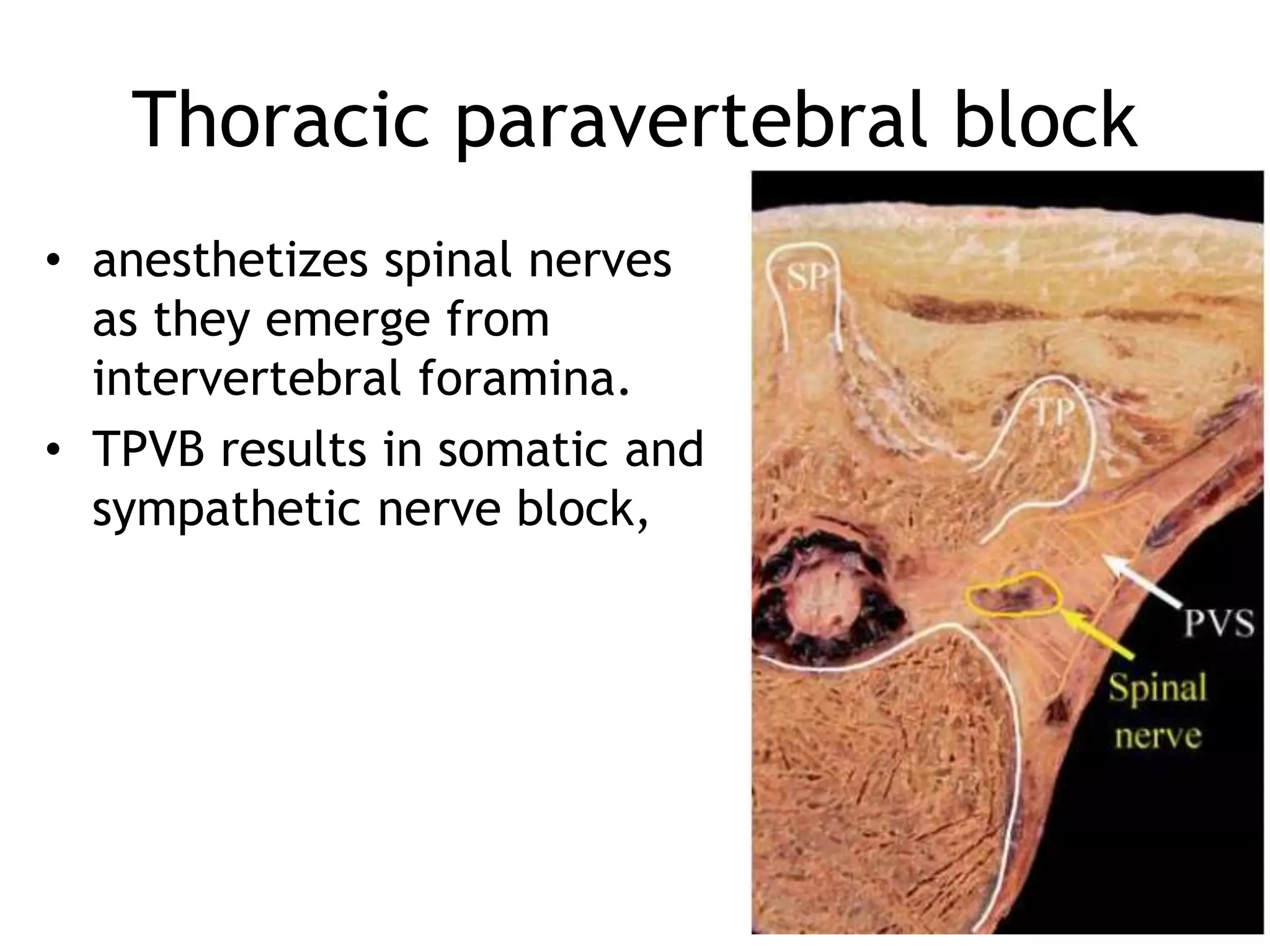 Thoracic paravertebral block
• anesthetizes spinal nerves
as they emerge from
intervertebral foramina.
• TPVB results in somatic and
sympathetic nerve block,
52
 