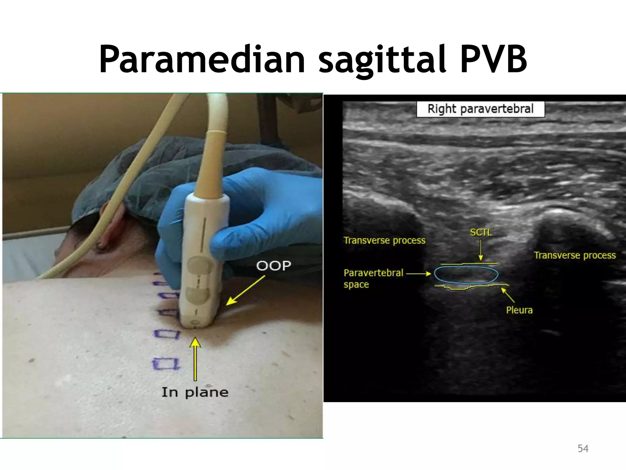 Paramedian sagittal PVB
54
 