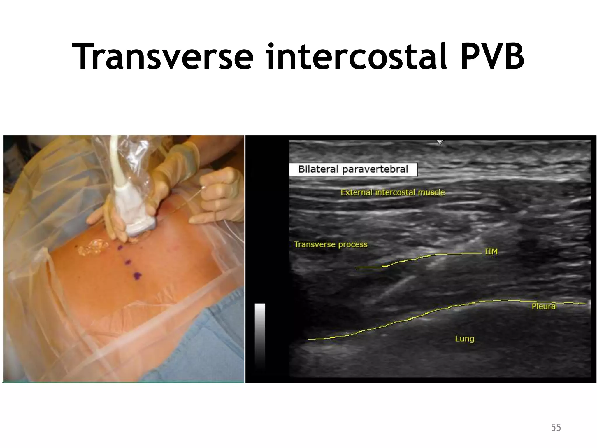 Transverse intercostal PVB
55
 