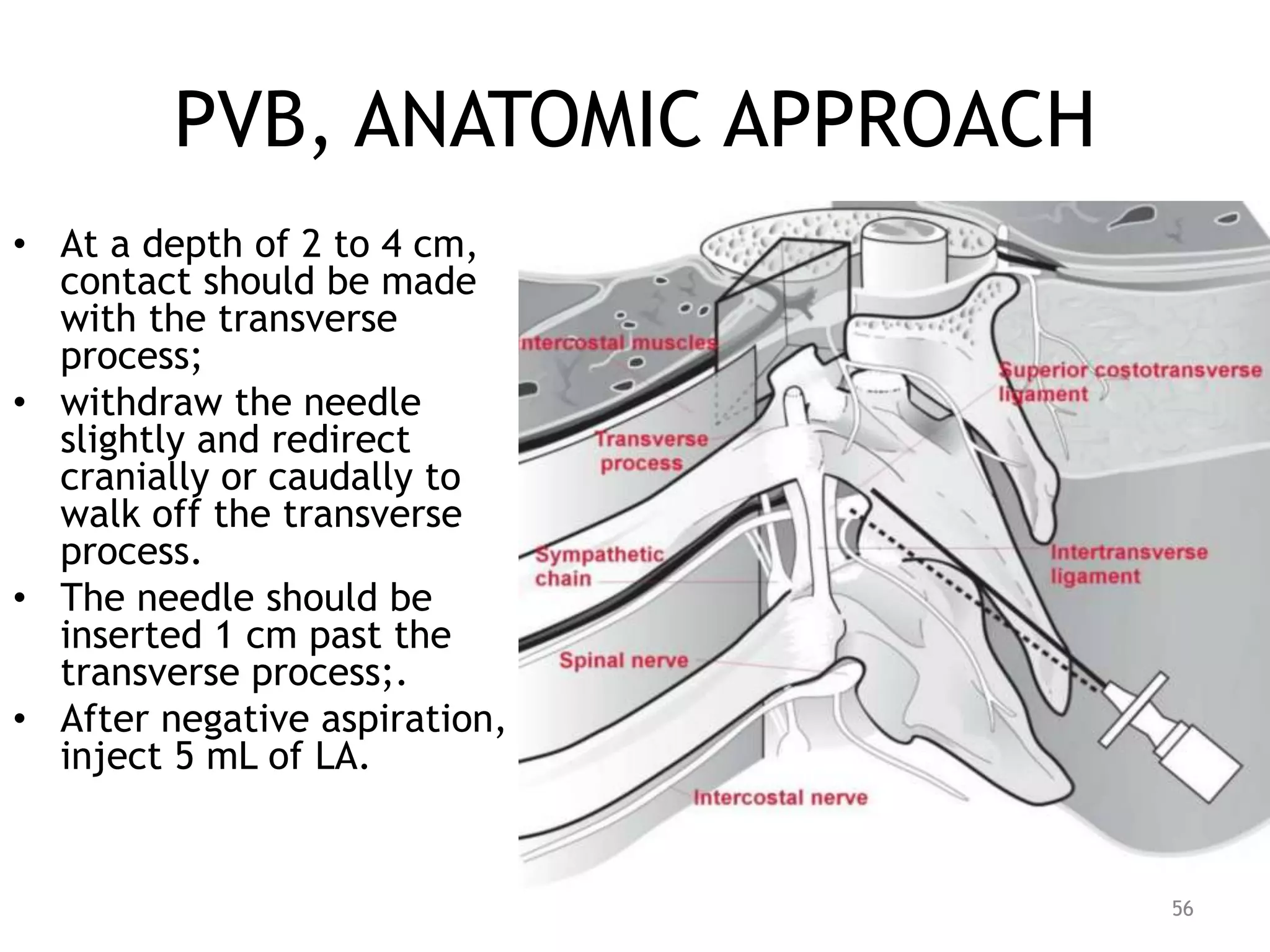 PVB, ANATOMIC APPROACH
56
• At a depth of 2 to 4 cm,
contact should be made
with the transverse
process;
• withdraw the needle
slightly and redirect
cranially or caudally to
walk off the transverse
process.
• The needle should be
inserted 1 cm past the
transverse process;.
• After negative aspiration,
inject 5 mL of LA.
 