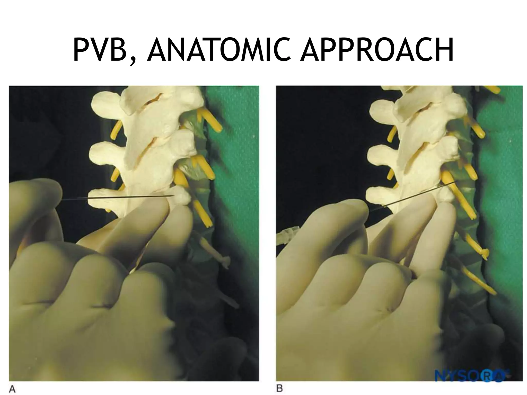 PVB, ANATOMIC APPROACH
58
 