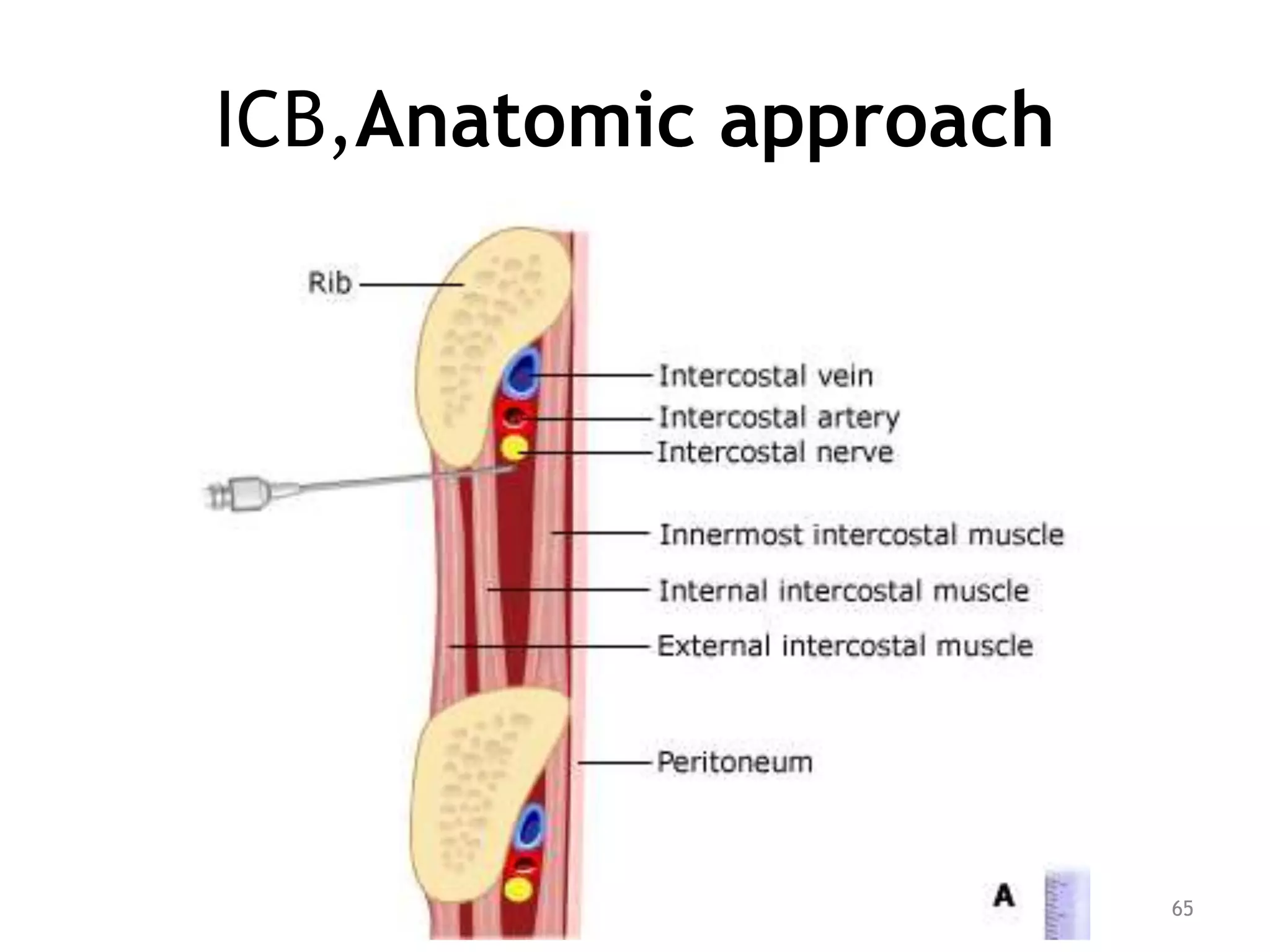 ICB,Anatomic approach
65
 