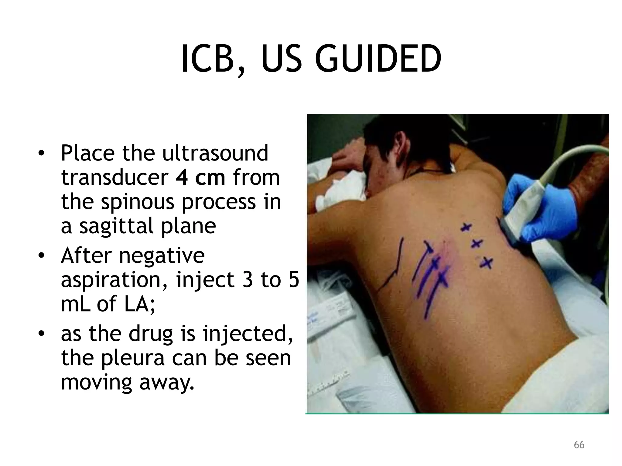 ICB, US GUIDED
• Place the ultrasound
transducer 4 cm from
the spinous process in
a sagittal plane
• After negative
aspiration, inject 3 to 5
mL of LA;
• as the drug is injected,
the pleura can be seen
moving away.
66
 