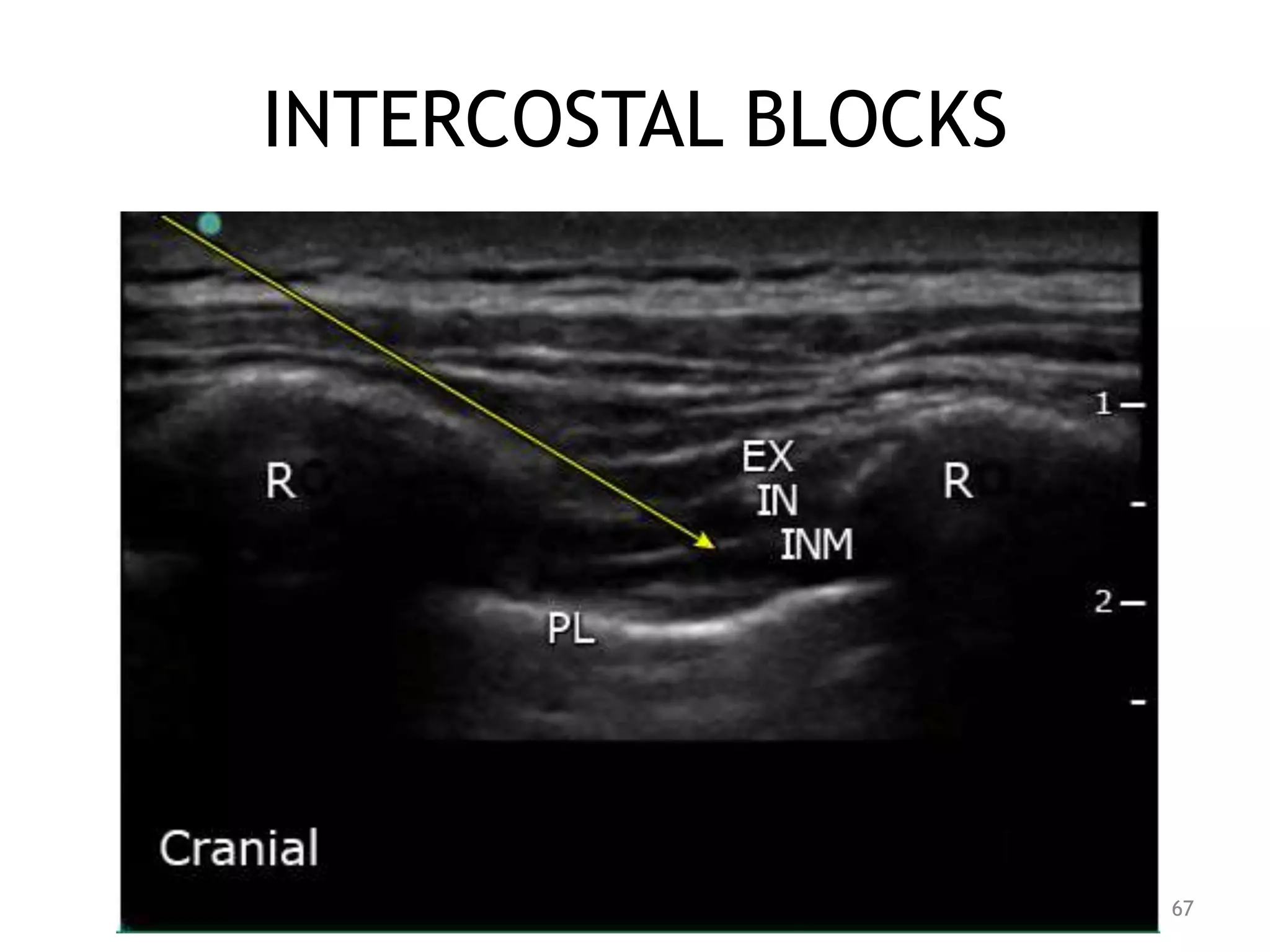 INTERCOSTAL BLOCKS
67
 