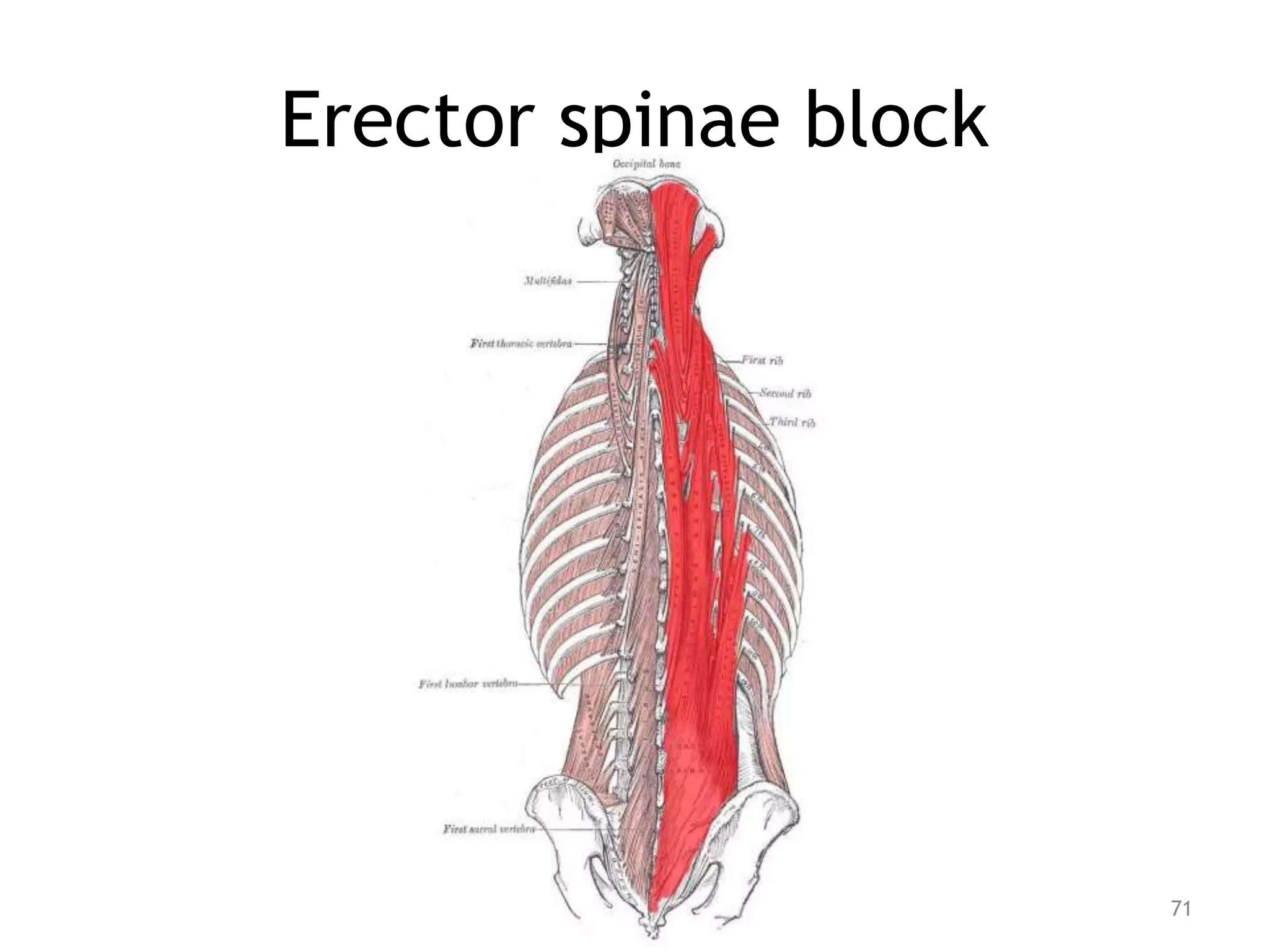 Erector spinae block
71
 
