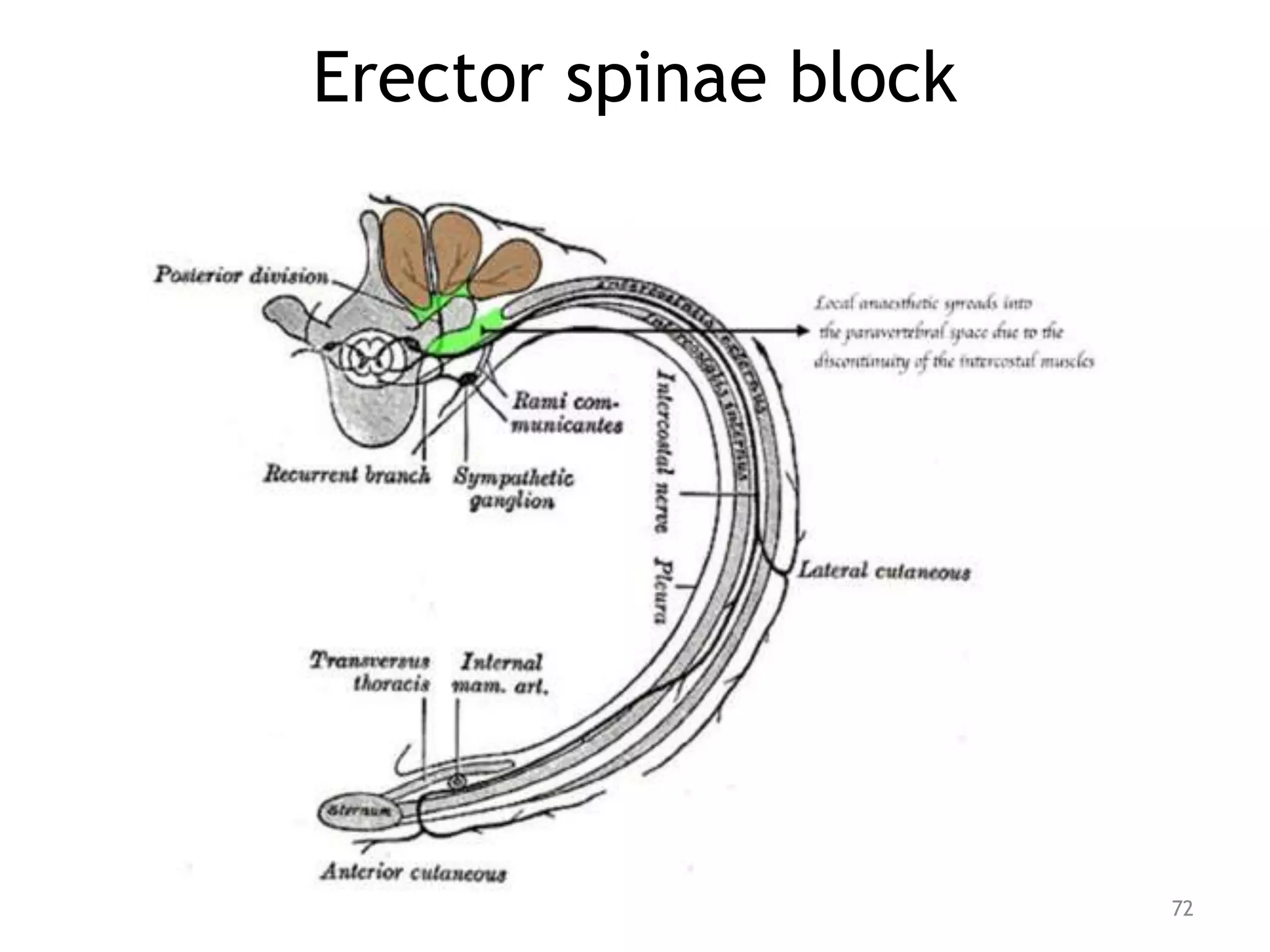 Erector spinae block
72
 