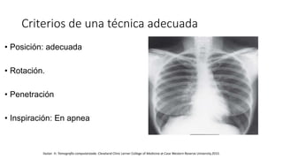 Criterios de una técnica adecuada
• Posición: adecuada
• Rotación.
• Penetración
• Inspiración: En apnea
Ilaslan H. Tomografía computarizada. Cleveland Clinic Lerner College of Medicine at Case Western Reserve University.2015.
 