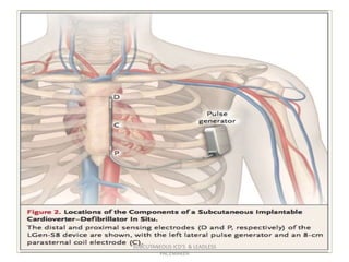 SUBCUTANEOUS ICD'S & LEADLESS
PACEMAKER
 