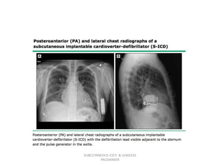 SUBCUTANEOUS ICD'S & LEADLESS
PACEMAKER
 