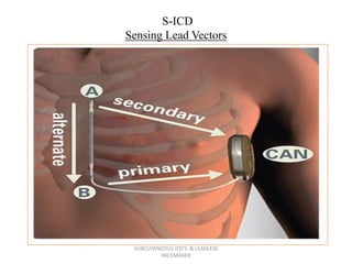 S-ICD
Sensing Lead Vectors
SUBCUTANEOUS ICD'S & LEADLESS
PACEMAKER
 