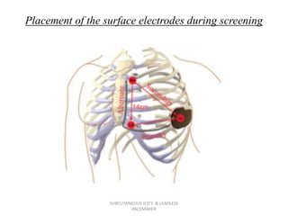 Placement of the surface electrodes during screening
SUBCUTANEOUS ICD'S & LEADLESS
PACEMAKER
 