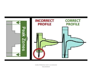SUBCUTANEOUS ICD'S & LEADLESS
PACEMAKER
 
