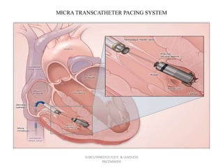 MICRA TRANSCATHETER PACING SYSTEM
SUBCUTANEOUS ICD'S & LEADLESS
PACEMAKER
 