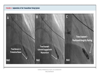 SUBCUTANEOUS ICD'S & LEADLESS
PACEMAKER
 