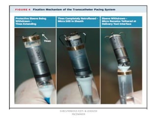 SUBCUTANEOUS ICD'S & LEADLESS
PACEMAKER
 