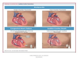 SUBCUTANEOUS ICD'S & LEADLESS
PACEMAKER
 