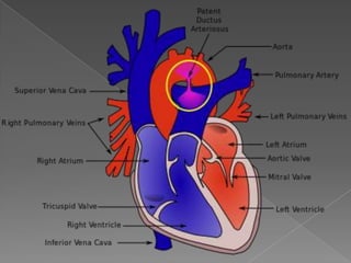 Seminar congenital cardiac disorders (pda,TA and AP Window) | PPTX
