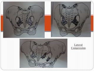 Lateral Compression Text Pelvic Complex Fracture | PPTX