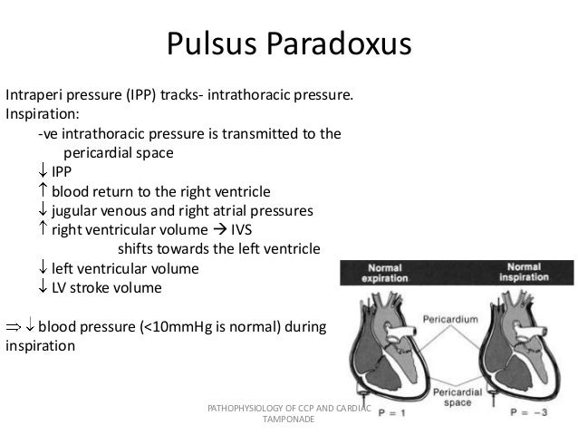 Pathophysiology of ccp and cardiac tamponade Pathophysiology of ccp and cardiac tamponade
